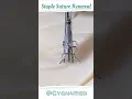 Staple Suture Removal Technique