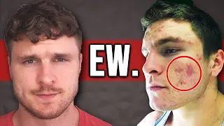 acne makes you disgusting 