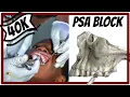 POSTERIOR SUPERIOR ALVEOLAR NERVE BLOCK TECHNIQUE Tuberosity block