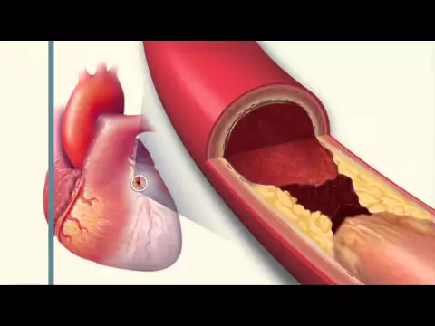 Download MP3 NSAIDs and Heart Disease - Mayo Clinic