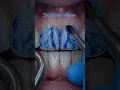 Watch How a Dentist Protects Tooth Enamel Using Modern Restorative Techniques to Reinforce Surface