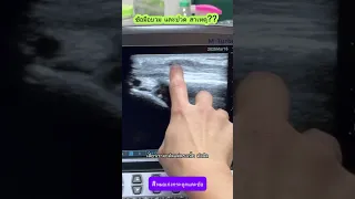  อาการบวมและเจ็บที่เอ็นตรงข้อเท้าเกิดจากสาเหตุอะไร 