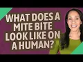 What does a mite bite look like on a human