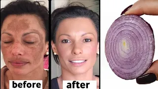 Mix onion with cornstarch to achieve firmer skin, free from wrinkles and pigmentation.