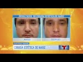 Dr Carlos Wolf - Un Nuevo Dia sobre rinoplastia