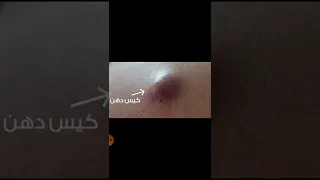 الفرق بين الكيس الدهني والورم Radiographer Lipomarcacion Shorts 