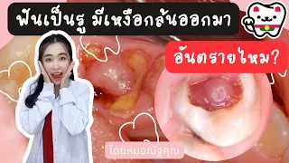  เหงือกบวมและมีของเหลวไหลออกมาจากเหงือก อาจเกิดจากสาเหตุอะไรบ้าง 