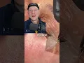Download Lagu Chemical Peel Skin PEELING! | Plastic Surgeon Reacts