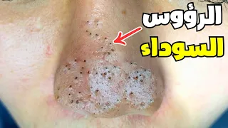 شاهد كيف تتكون الرؤوس السوداء وماهي افضل 5 طرق لتخلص منها نهائيا _ SATISFYING Blackhead Removal