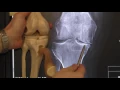 Knee Osteoarthritis Xray Findings