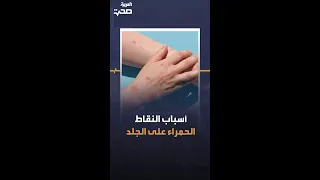 أسباب النقاط الحمراء على الجلد 
