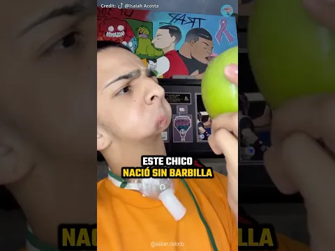 NACIÓ SIN MANDÍBULA Y TODOS SE BURLARON DE ÉL, PERO 3 AÑOS DESPUÉS SE ARREPINTIERON #shorts