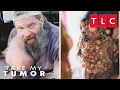 Download Lagu WATCH LIVE 🔴 Tumor Removals from Season 1 | Take My Tumor | TLC