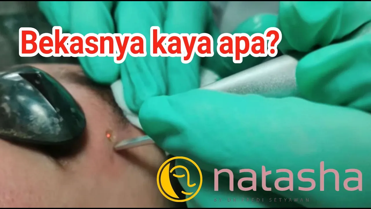 Nah guys di video kali ini aku bakal kasih tahu harga laser bekas luka. Dan treatment apa aja yang a. 