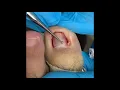 Download Lagu THE ULTIMATE INGROWN TOE-NAIL PERMANENT PROCEDURE 🦍🦈🦍🦈🦍🦈🦍