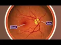 Download Lagu Animation: Age-related Macular Degeneration