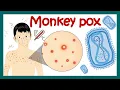 Monkey Pox Virus How monkeypox is transmitted Symptoms and treatment of monkeypox Rare virus