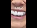 Lying About Wearing Retainers To Your Orthodontist
