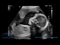 Download Lagu Scan of the Week: 22 Week Anomaly Scan
