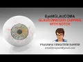 Innovative Pedagogy - Glaucomatous Notch with Corresponding RNFL Defect in 1 Minute