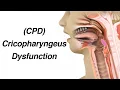 Cricopharyngeus Dysfunction CPD Causing Dysphagia or Trouble Swallowing