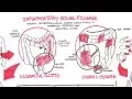 Download Lagu Inflammatory Bowel Disease - Crohns and Ulcerative Colitits