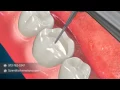 Tooth Restoration Procedures Inlay