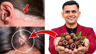 Itchy, Flaky Scalp? Try This Natural Remedy for Scalp Psoriasis