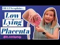 Low Lying Placenta Explained Risks Sex Exercise C-section vs Vaginal birth Marginal previa