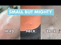 3 Small But Mighty Bumps Head Neck Back Cysts Dr Pimple Popper