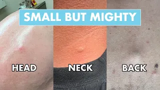 3 Small But Mighty Bumps Head Neck Back Cysts Dr Pimple Popper