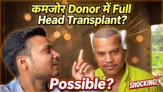 कमजोर डोनर एरिया फुल हेड हेयर ट्रांसप्लांट कैसे होगा