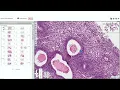 Endometrial Pathology for the Practicing Pathologist by Marisa Rose Nucci M D