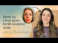 How to clear post-birth control acne