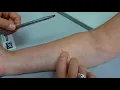 Tb Skin Test Read