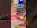 3 ways NOT to eat WATERMELON with BRACES what to eat instead