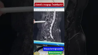  กระดูกยุบใหม่กับกระดูกยุบเก่าต่างกันอย่างไรในภาพ MRI 