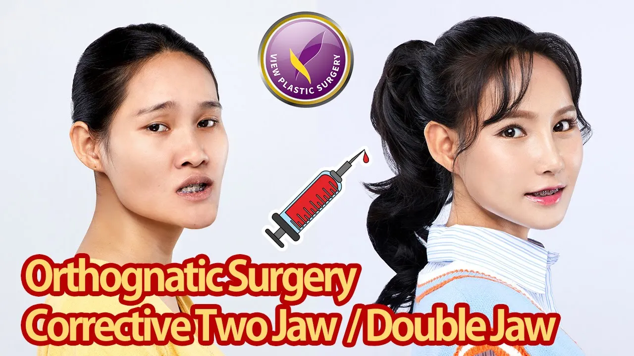 Double Jaw, Facial contouring surgery, Fat Graft and Rhinoplasty (Korea Plastic Surgery)