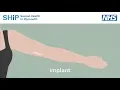 Having a contraceptive implant fitted