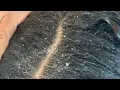 Download Lagu Dandruff Scratching with Mom! Pt.1