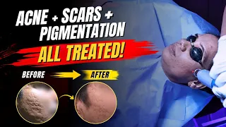 Acne Scars + Pigmentation: See The 6-Month Results! | Case Study | Clear Skin Clinic, Pune