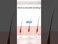 Can Minoxidil Cure Baldness