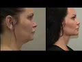 Non-Surgical Neck Lift with a PDO Thread Lift and Botox