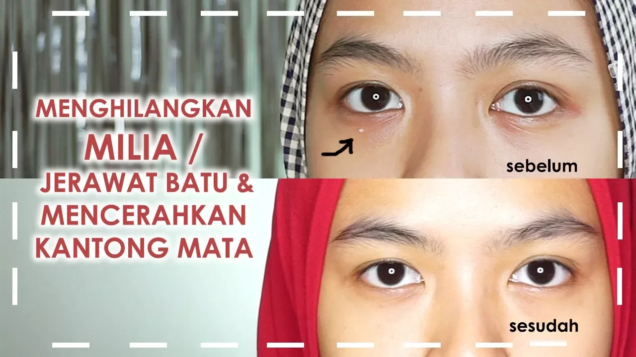 
          
          
          
            
            Cara Menghilangkan Milia (Jerawat Batu) & Mencerahkan Kantung Mata | Avoskin Intensive Eye Cream
          
        . 