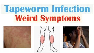 Weird Symptoms of Tapeworm Infection Skin Psychological Neurological
