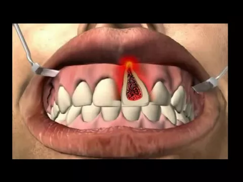 Fistula
