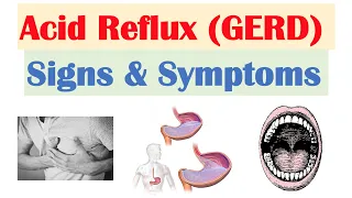 Download Gastroesophageal Reflux Disease (GERD) Signs \u0026 Symptoms (ex. Bad Teeth) | \u0026 Why They Occur MP3