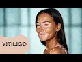 FDA-Approved Cream for Vitiligo Real Results or Just Hype