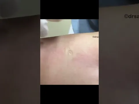This was hiding under the skin!