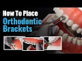 How to Place Orthodontic Brackets Step by Step Guide for Dentists